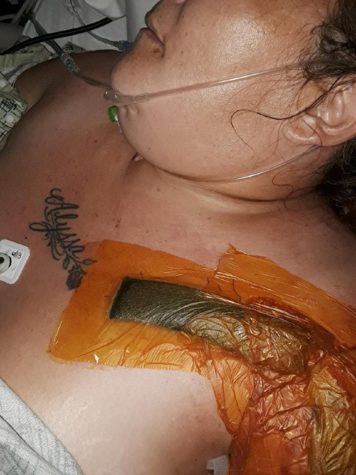  Tamara Owsley-Savard, 32, from Kansas, was left fighting for life after a spider bite got infected with a 'flesh-eating bug'