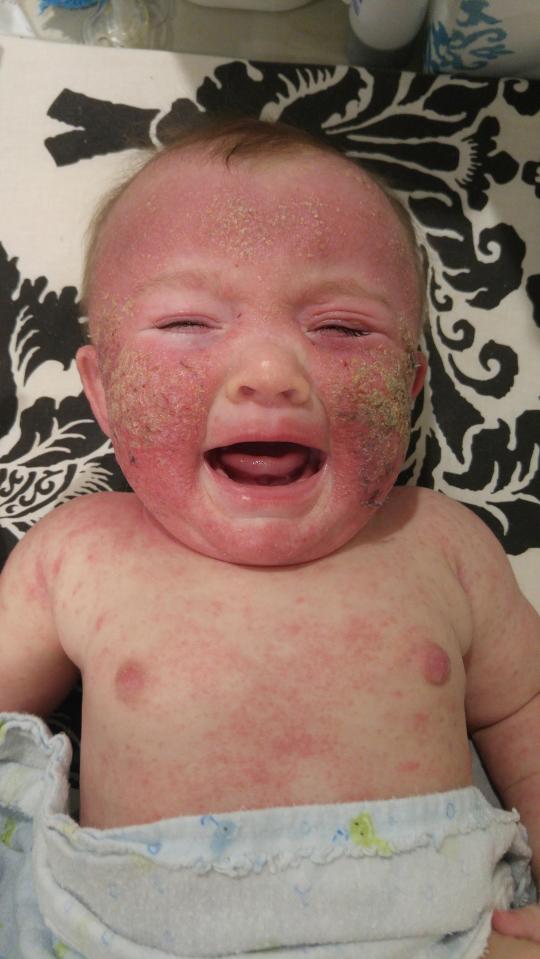 Little Indica suffered nasty eczema from newborn