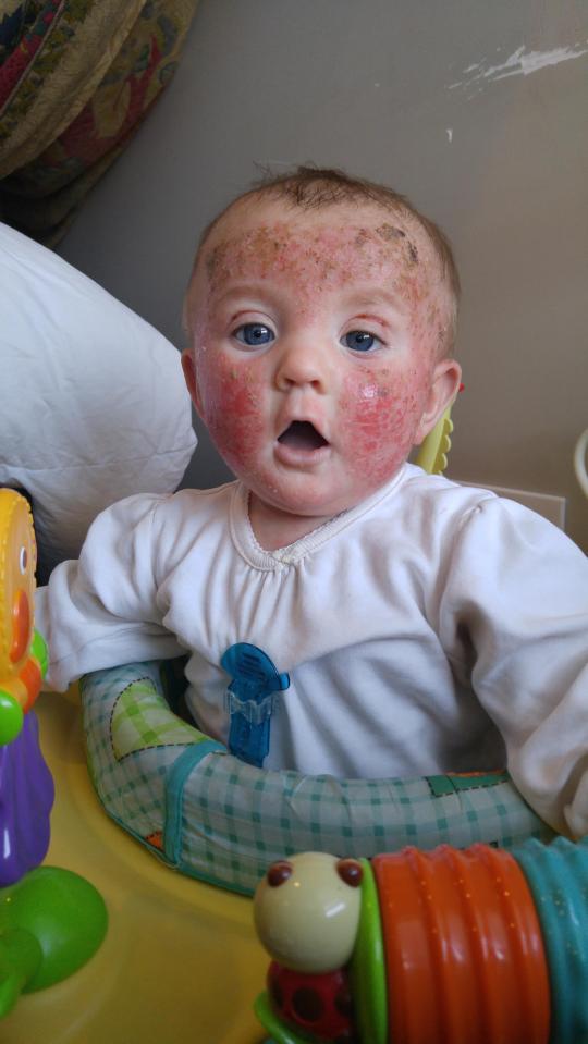 The eight-month-old was suffering topical steroid syndrome, where the skin becomes dependent on the medication