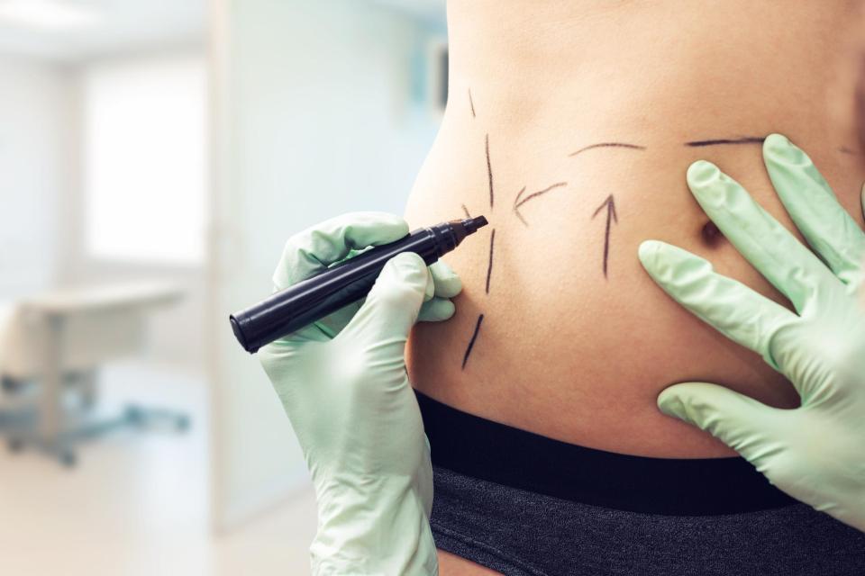  Liposuction is not a cure for obesity