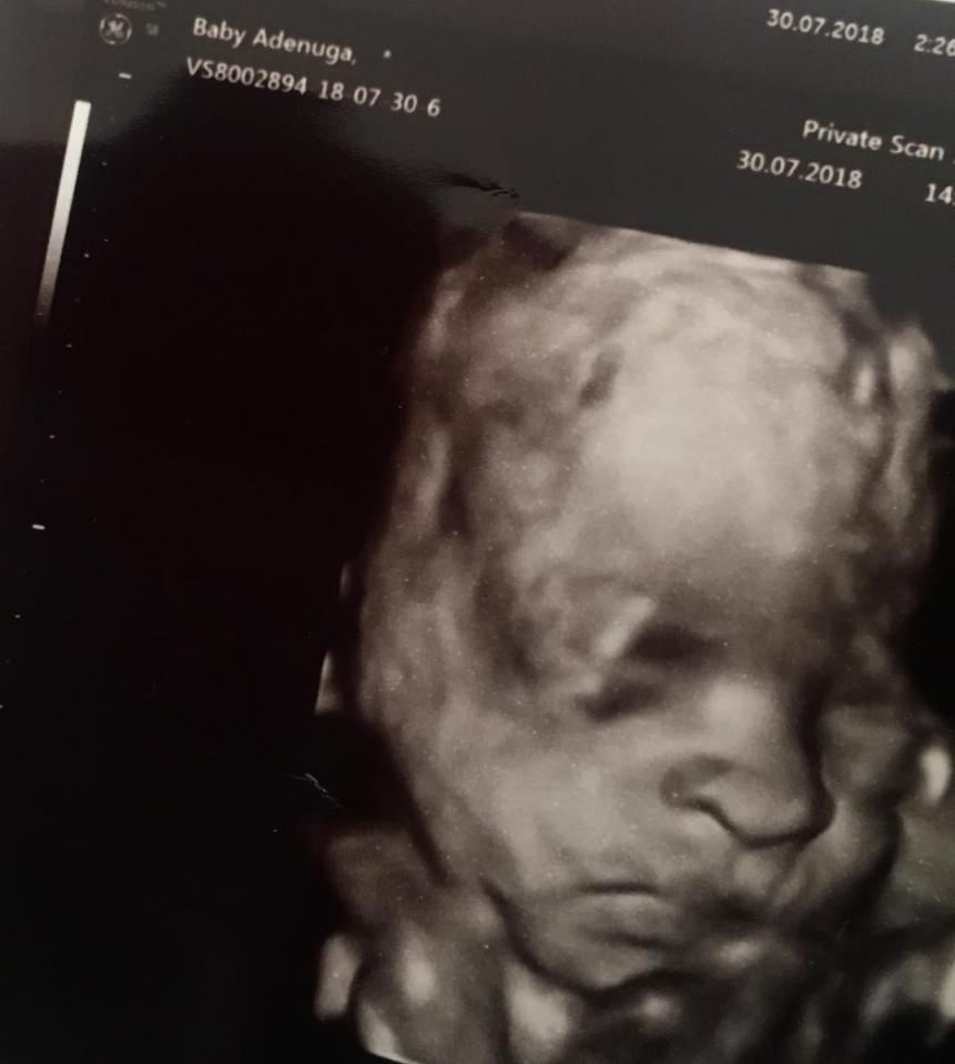  The grime artist posted a picture of an ultrasound online