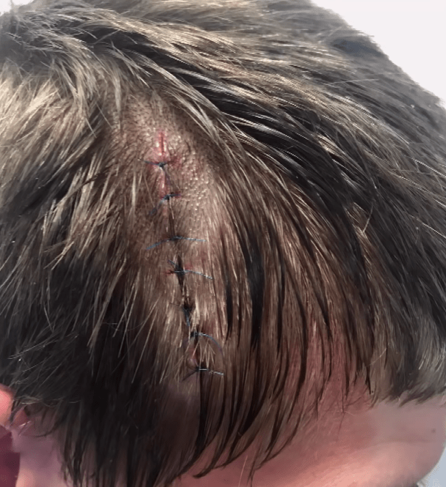  Desperate to silence the voice, Kyle slashed his own head after four months of torment