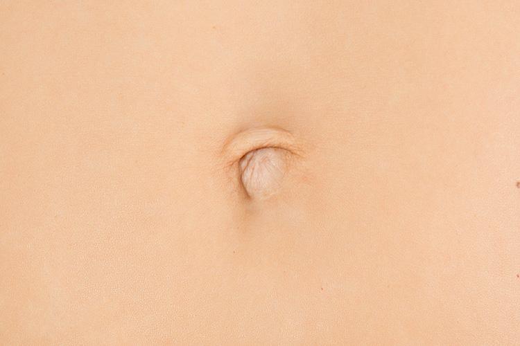  Off-centre navel