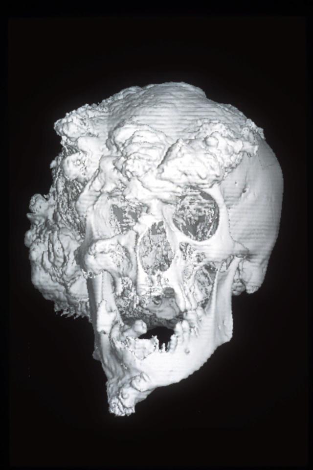  Above, the skull of Joseph Merrick