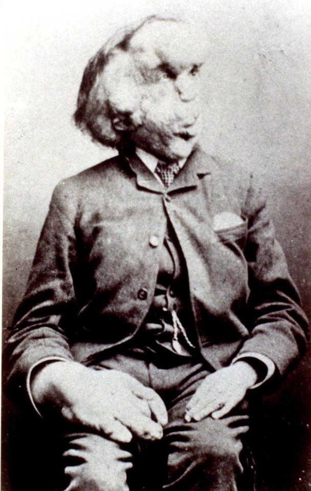  Pictured above, the Elephant Man Joseph Merrick