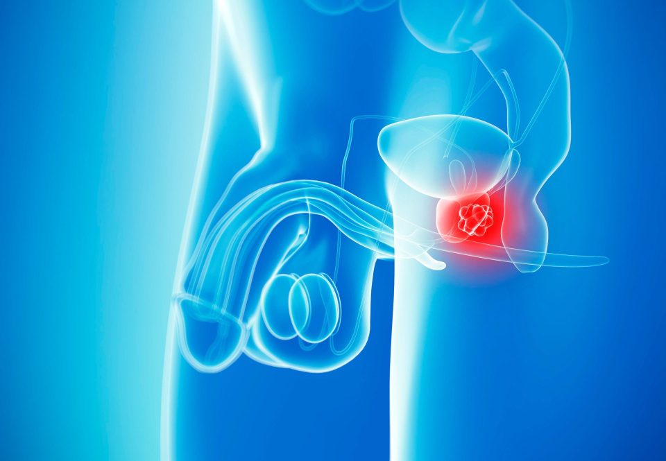  While low-grade prostate cancer often causes little harm, aggressive versions of the disease can quickly spread and prove fatal without radical treatment