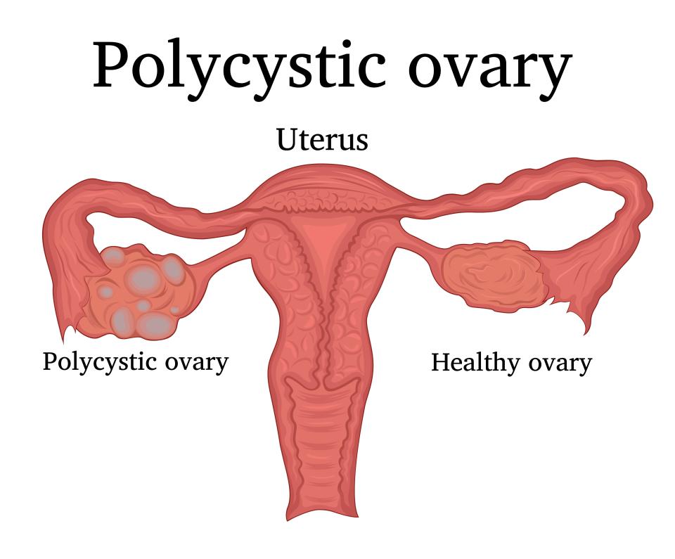  One in ten women have PCOS, which can be affected by lifestyle