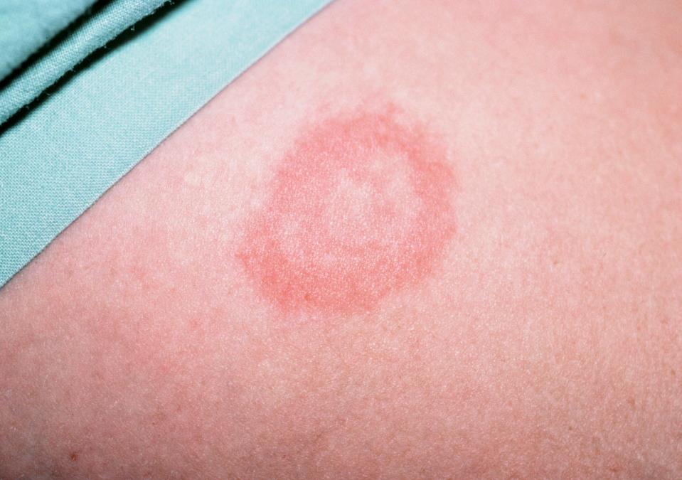  What a tick bite rash might look like