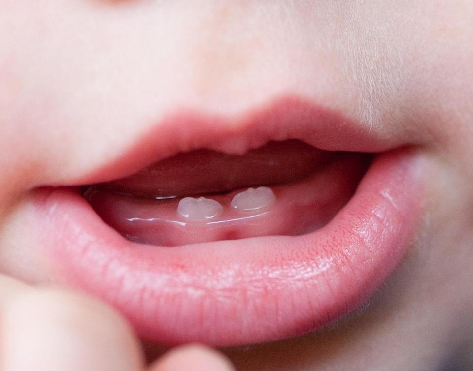  Most babies' milk teeth come through around the six month mark