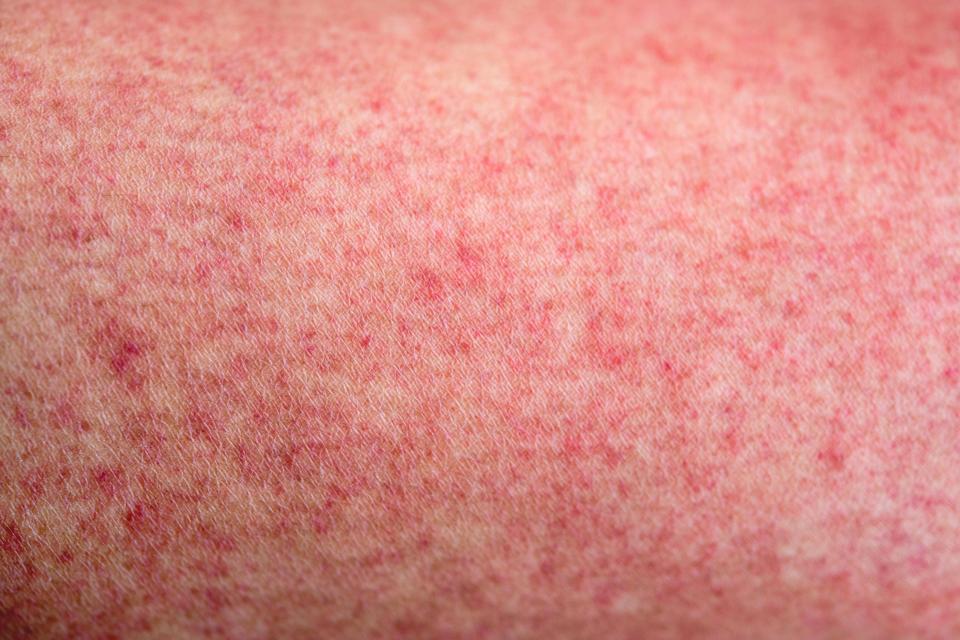 A haemorrhagic rash looks like red pin pricks on the skin