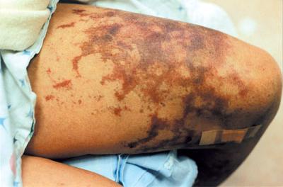 The rash can develop to look like a bruise