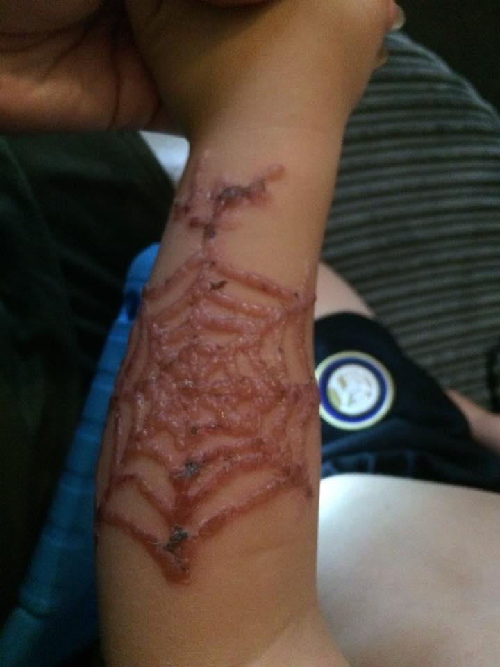  The NHS warns against having black henna tattoos while abroad