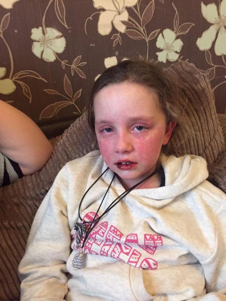  Alexa was allowed home after six weeks in hospital but it has taken much longer for her to recover fully