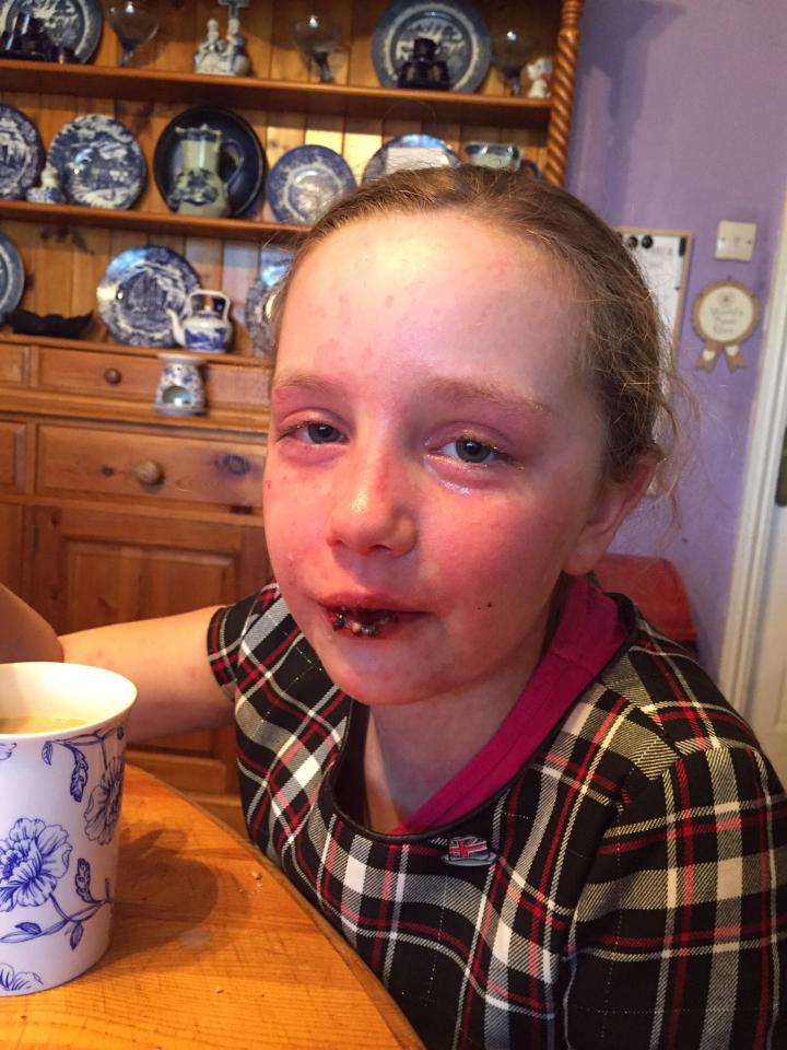  Within days of taking the medication Alexa started experiencing allergic reaction symptoms