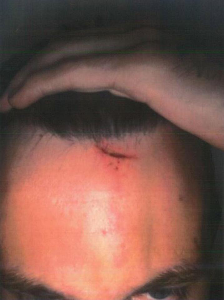  Hale was left with a cut on his forehead