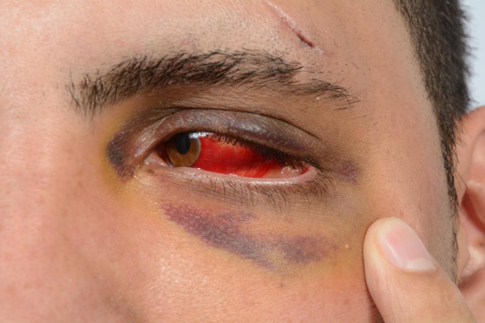  Ali had a black and bloodshot eye following the incident