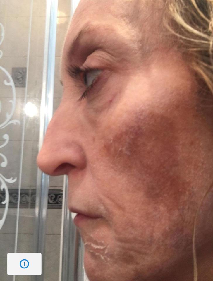  The 49-year-old realised one side of her face was ageing prematurely two years ago