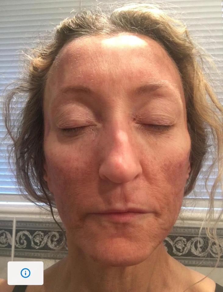  A chemical peel, which picks up sun damage, highlighted the issues on the left side of her face