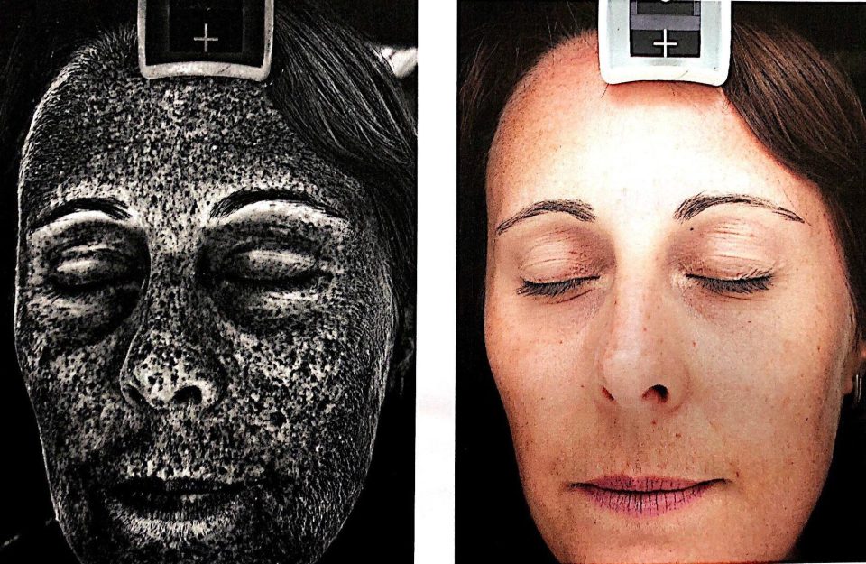  'The black areas indicate irreversible DNA damage caused by UV radiation', says Dr Sophie