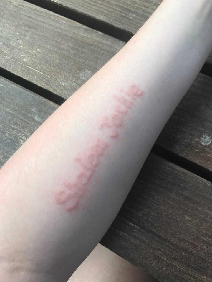  It was eight days after she had the tattoo done in July that she started to suffer a burning sensation on her arm