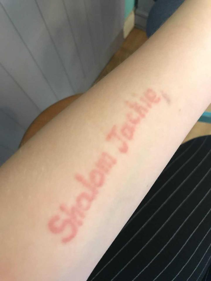  She's been left with the words 'Shalom Jackie' - a quote from Channel 4's Friday Night Dinner - on her arm