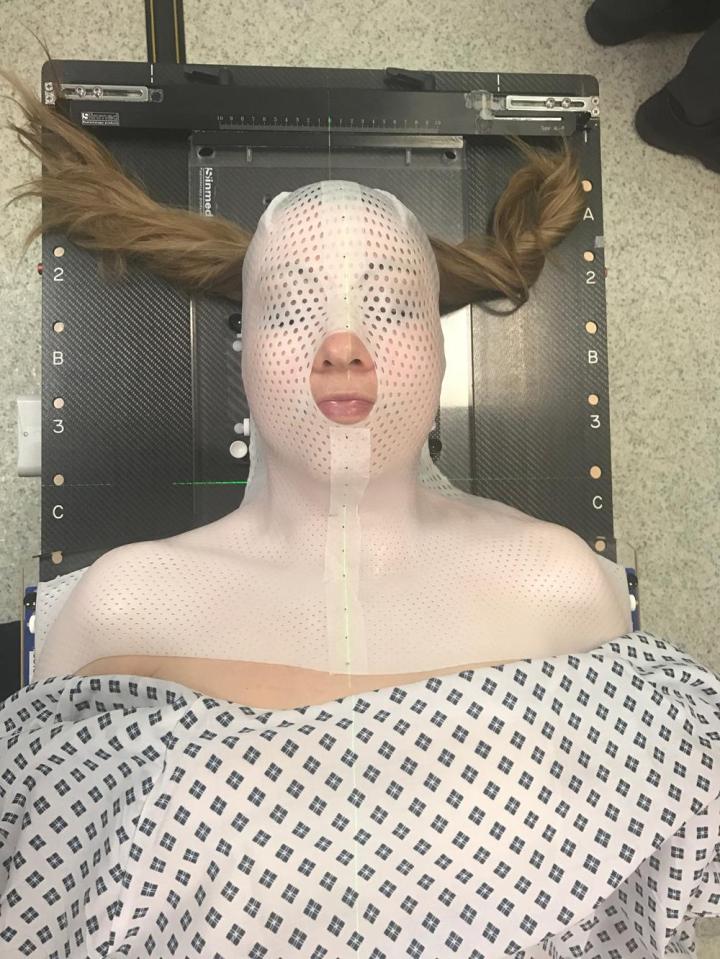  Sarah, pictured during radiotherapy treatment for skin cancer