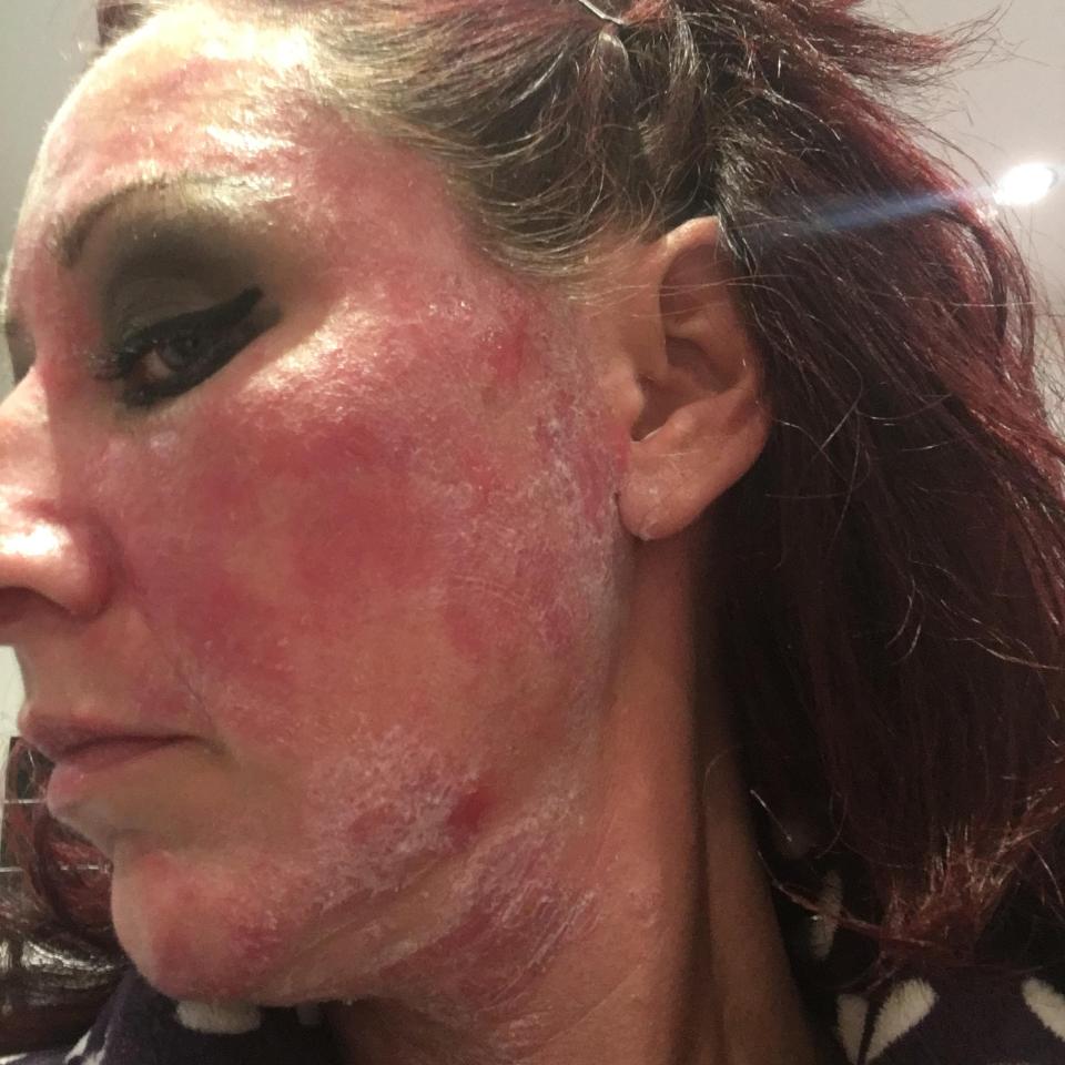 The withdrawals caused her psoriasis to come back twice as bad