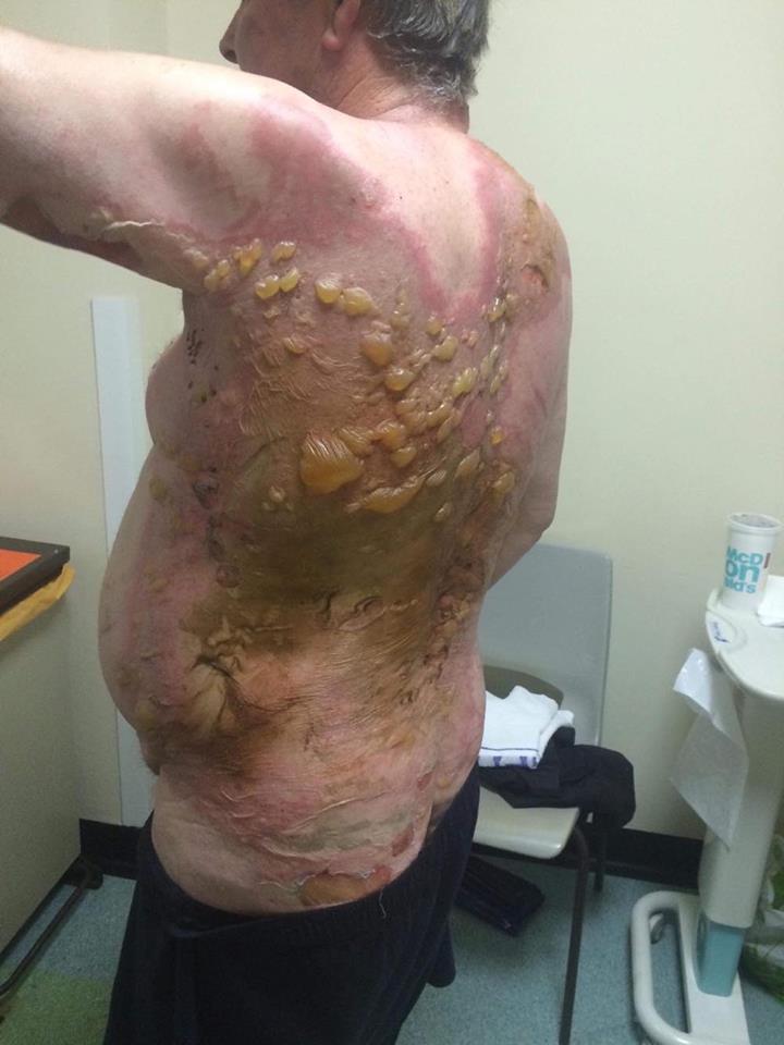  George Stewart, 67, was covered with large blisters all over his back as a result of the arson attack