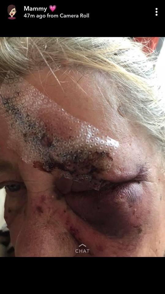  Martha Stewart's appalling injuries were shown in photos on social media