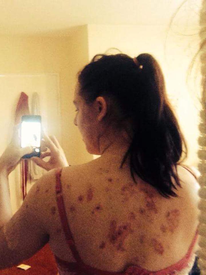 Cheryl's eczema also spread down her back