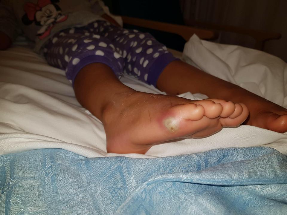 Doctors believe the infection entered Sienna's body through an existing cut or graze on her foot