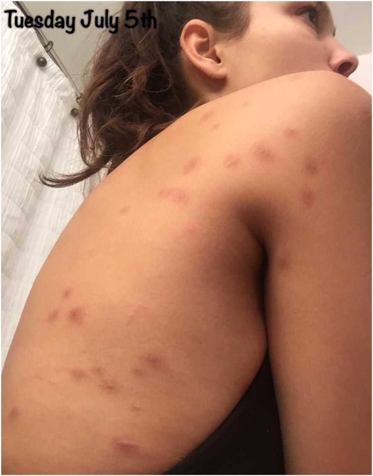  The Brazilian model said almost her entire body was covered in bites