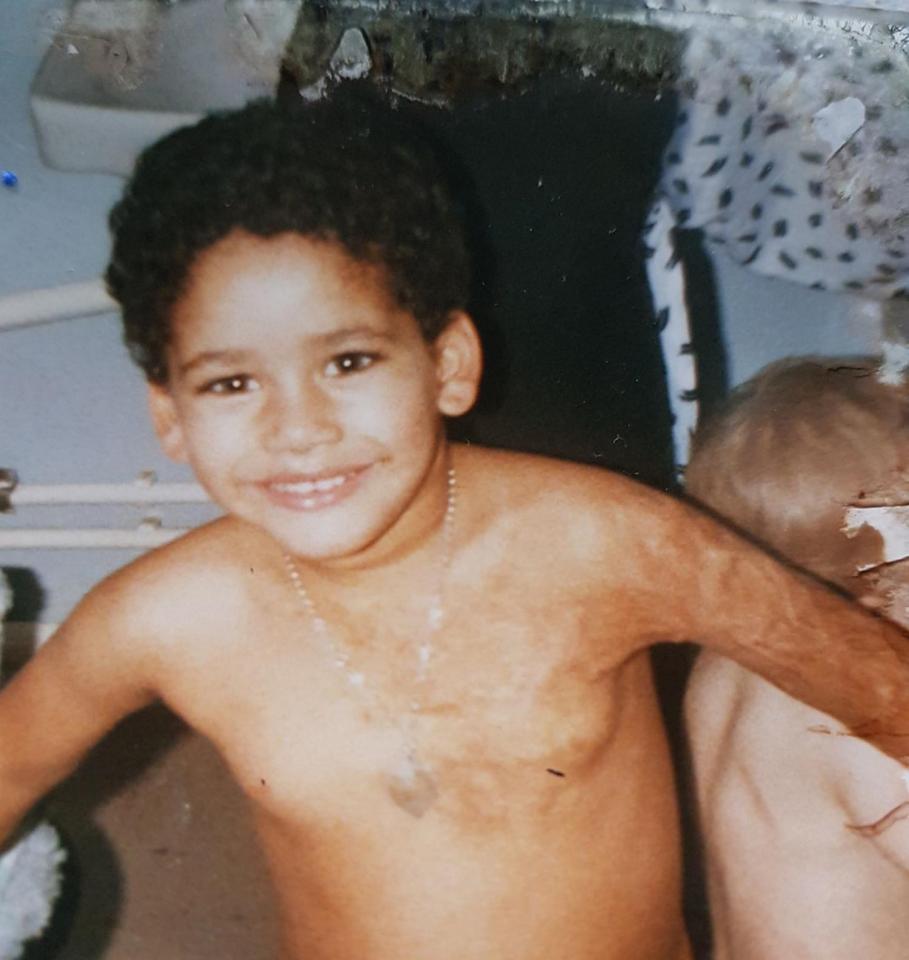  As a child Jay was bullied by others kids because of his scars