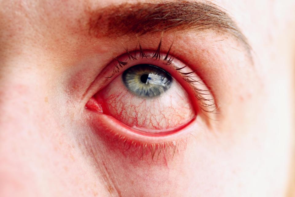 Acanthamoeba keratitis is a bacterial infection that causes the surface of the eye to become painful and inflamed