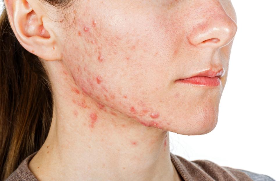  Oestrogen reduces acne, while testosterone increases it