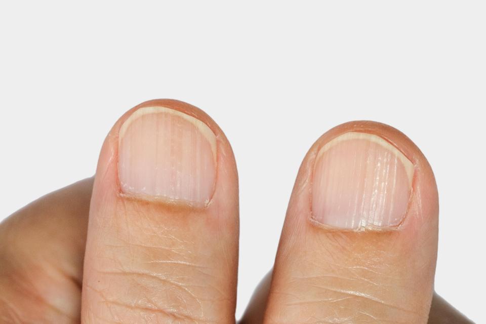  The main issue with ridged nails is cosmetic