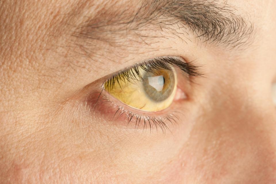  Yellow eyes or skin are often linked to liver problems