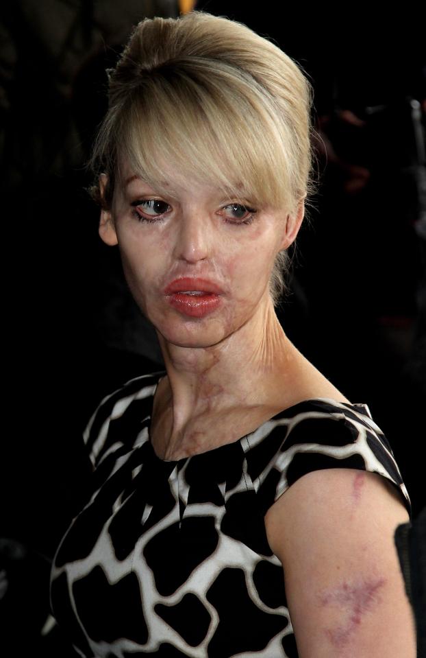  Katie has had more than 250 operations after being attacked with acid