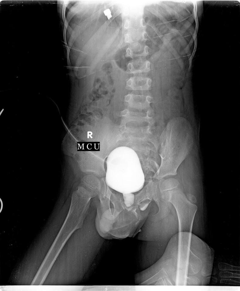 Scan's of the child's bladder (highlighted) showed his urethra was blocked