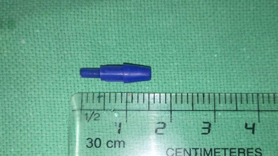 The pen tip was removed using surgical forceps