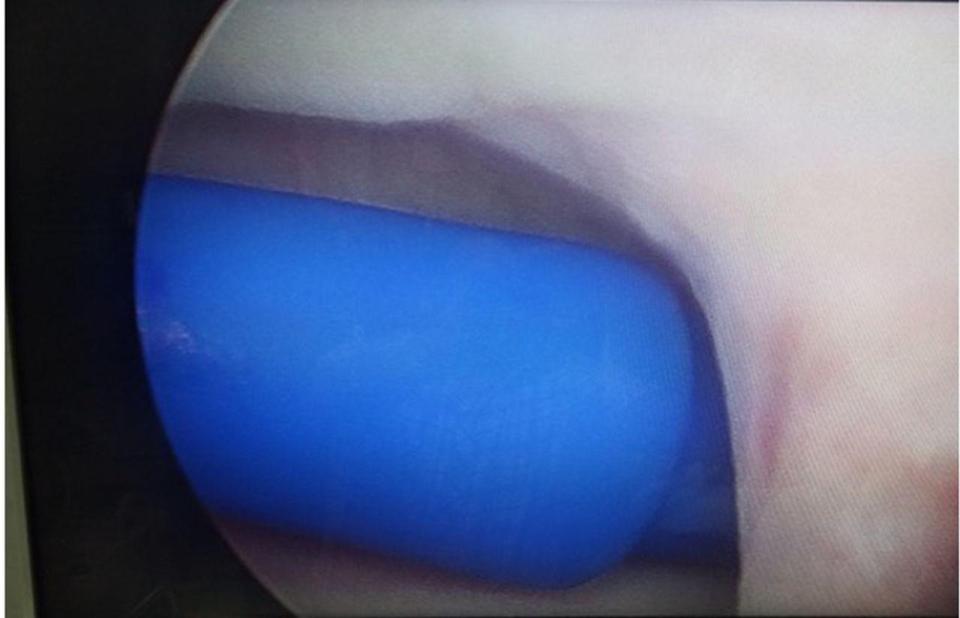 Doctors noticed a 'glistening blue plastic material' when they used a camera to look inside his urethra