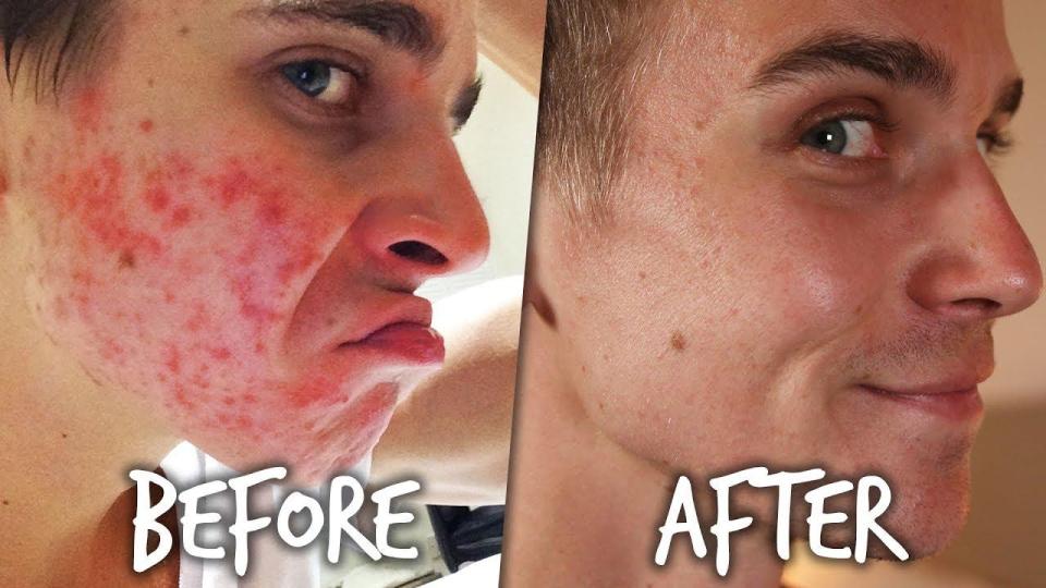  Joe Sugg revealed how he used to have acne, but that it has since cleared up