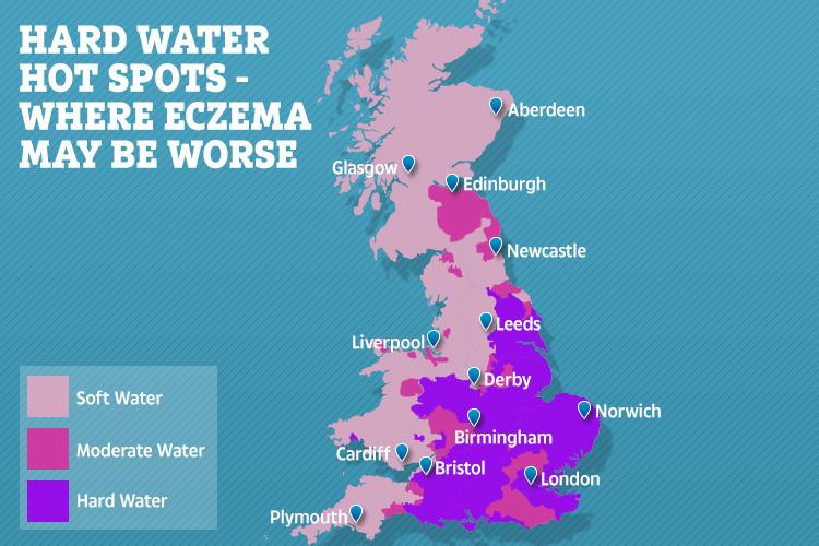 If you live in an area with hard water then your child might be at a higher risk of eczema than those who live in areas with soft water