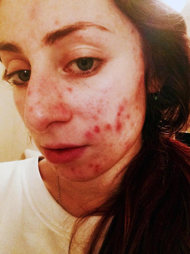  Sophie's acne stopped her from dating