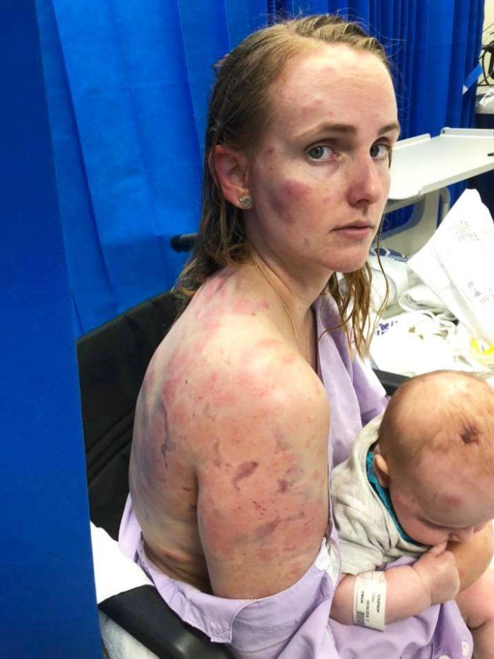  Fiona Simpson, above with daughter Clara, was left battered and bruised after hail blew out the windows in their car