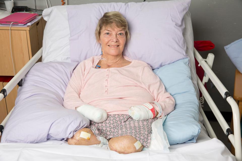  A gran who lost her arms and legs after a holiday infection has had her life transformed by a 3D printed bionic arm