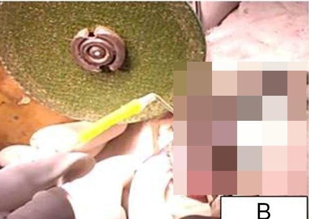 Doctors had to use an electric power tool to cut away the ball bearings after they cut off blood supply to the mans penis