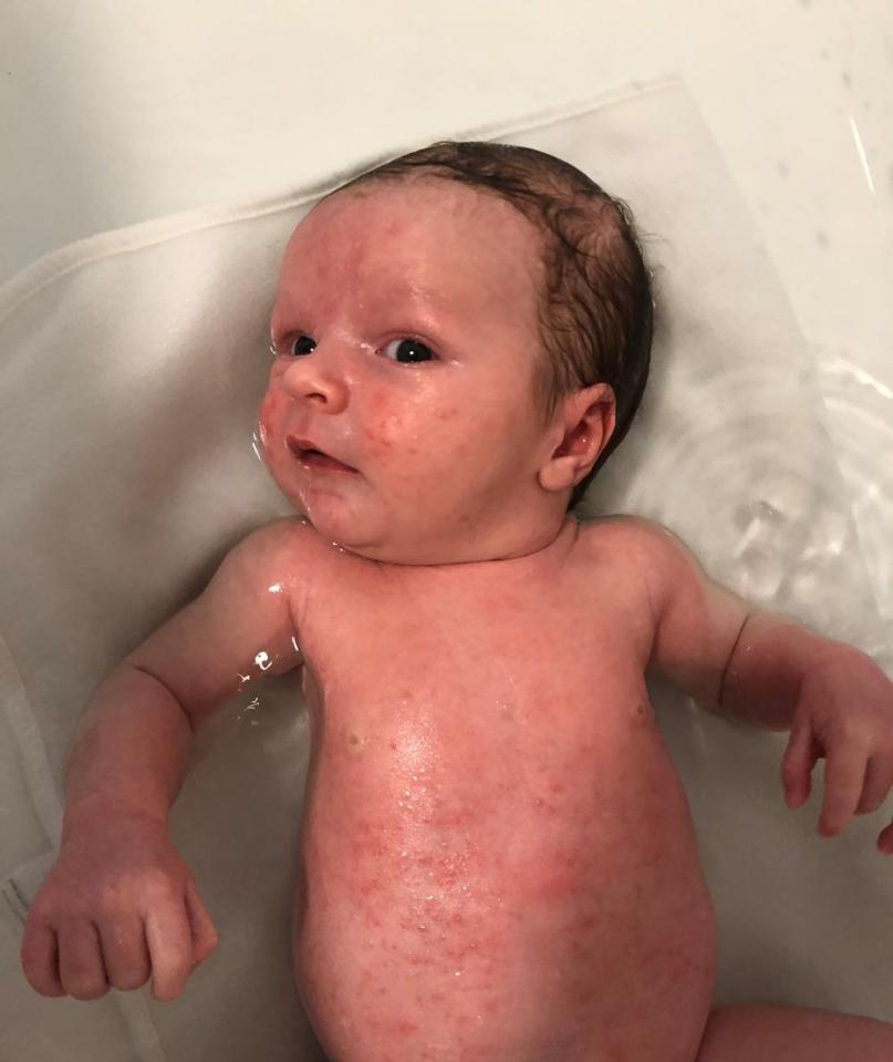  Henry was just weeks old when he broke out in acne all over his body