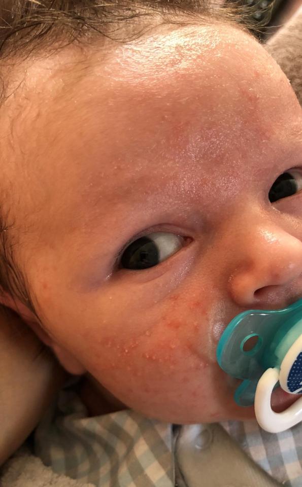  Alex had tried everything - including washing his face in breastmilk - to try to clear Henry's condition