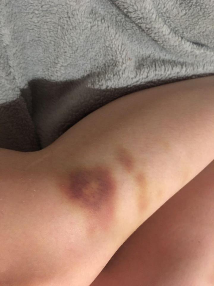  Elise woke up with bruises on her arms and legs and no memory of how she got home